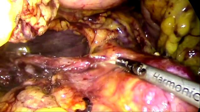 Live Différé 1: congrès national de chirurgie 2017. Chirurgie pancréatique par laparoscopie