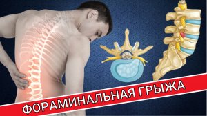 ФОРАМИНАЛЬНАЯ ГРЫЖА ПОЗВОНОЧНИКА. ЧТО ЭТО? КАК ЛЕЧИТЬ?