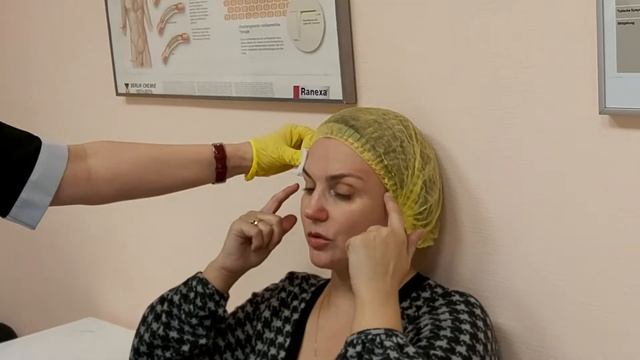 Подтяжка бровей и верхнего века нитями Коги.
