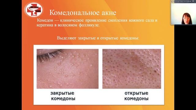 Школа здоровья онлайн. Тема занятия "Акне, или Все, что вы хотели знать про угревую болезнь".