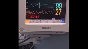 MANIOBRA TERAPÉUTICA DE VALSALVA para tratar una Taquicardia Supraventricular Paroxística