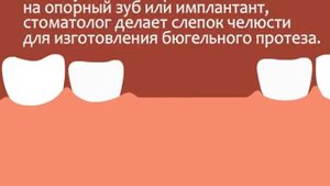 Процесс установки бюгельного протеза на зубы