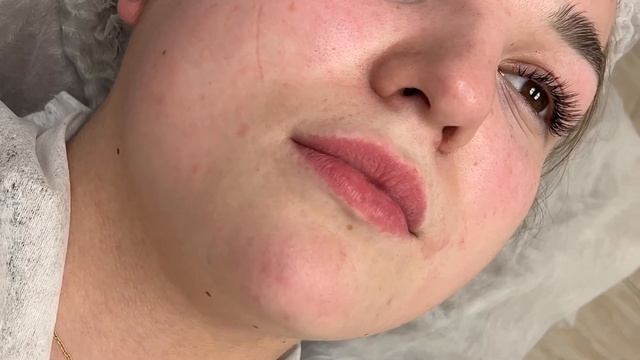 Контурная пластика губ (Журавлева Надежда) смотреть онлайн