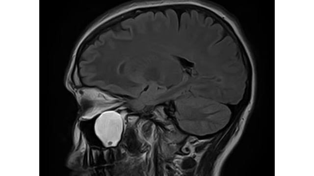 Заболевания околоносовых пазух смотреть онлайн