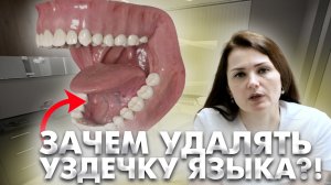 Зачем удалять уздечку языка или губы?