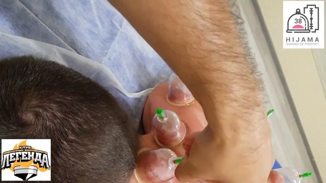 Жесть | что | с | ним | ? | вакуумный массаж | массаж банками | хиджама | спортивеый массаж | смотреть онлайн