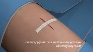 3M Steri-Strips™ Skin Closure Application | 3M Critical & Chronic Care Solutions