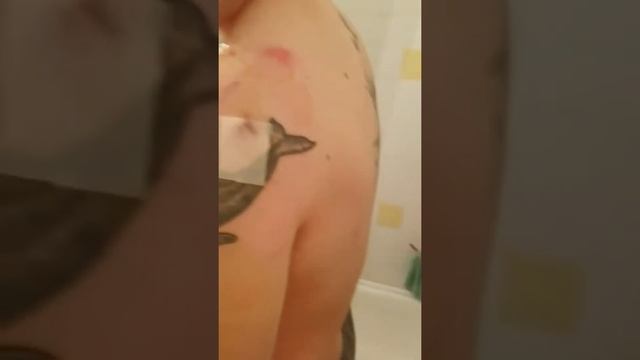 Biceps Tenodesis Shoulder Recovery Day 3 смотреть онлайн