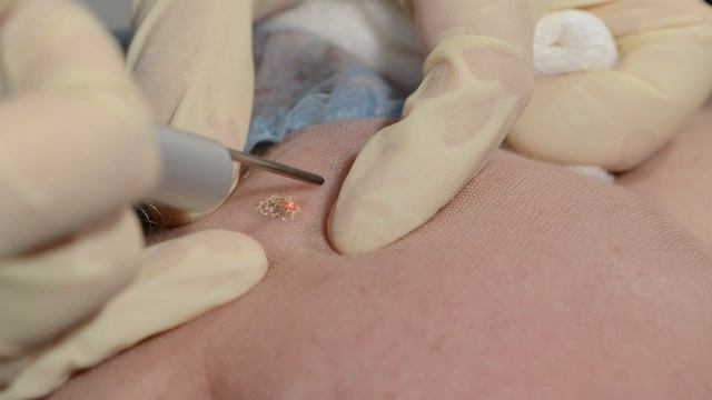 Удаление кератомы на лице лазерным методом