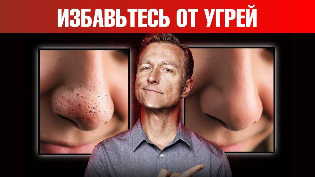 Как НАВСЕГДА избавиться от черных угрей и сальных нитей?