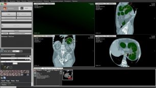 Режим обработки изображений колоноскопии на АРМ врача-диагноста "Гамма Мультивокс Д2"
