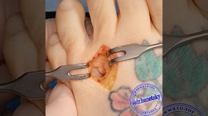 Что такое неврома Мортона и почему она не лечиться консервативно?