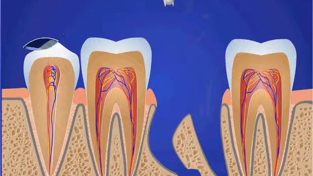 Удаление зуба средней сложности с разделением на части. Остеопластика смотреть онлайн