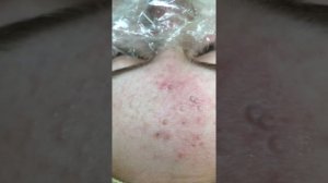 Механическая чистка лица