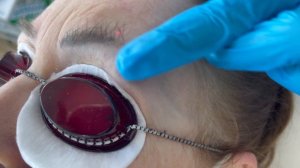 Удаление перманентного макияжа лазером.