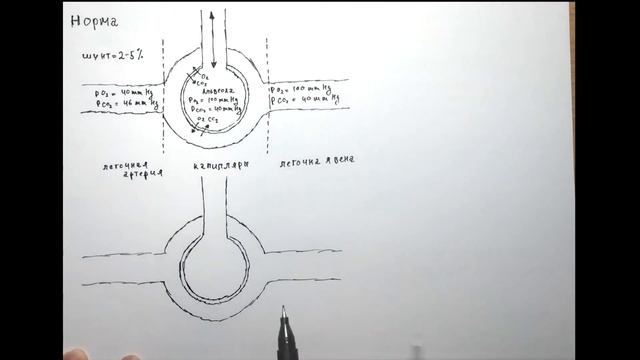 Острый респираторный дистресс-синдром (ОРДС) смотреть онлайн