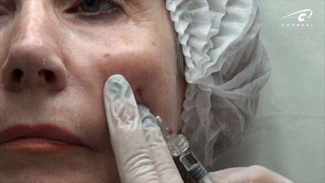 Коррекция средней трети канюлей. Восстанавливаем объем щек. Носослезная борозда. смотреть онлайн