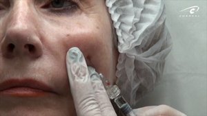 Коррекция средней трети канюлей. Восстанавливаем объем щек. Носослезная борозда.