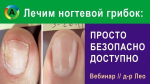 Как быстро избавиться от ногтевого грибка. Народное средство