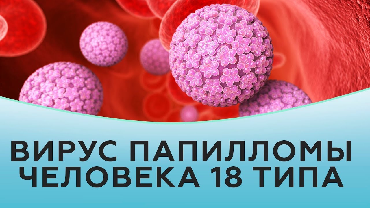 Вирус папилломы человека 18 типа.