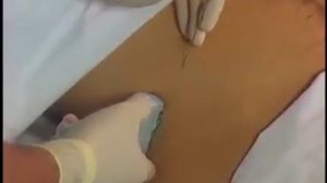 How To: Ultrasound Guided TAP Block