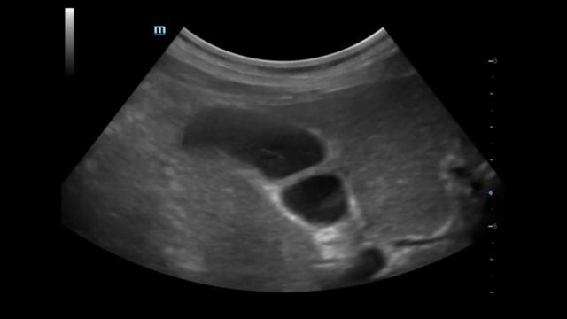 Возле желчного пузыря смотреть онлайн