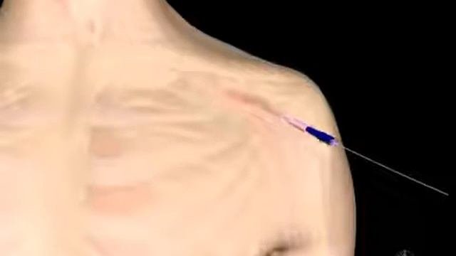 Аритмология   Кардиостимулятор Имплантация   The Implant Procedure For Pacemaker