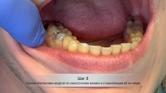 Реставрация бокового зуба без финального пришлифовывания по окклюзии.