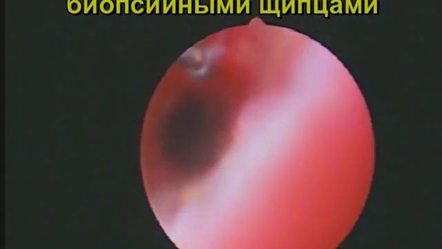 Плацентарный полип после родов. Гистероскопия.