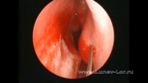 Лазерная деструкция нижних носовых раковин