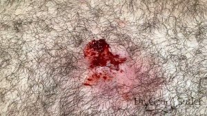 Removal of infected cyst from chest