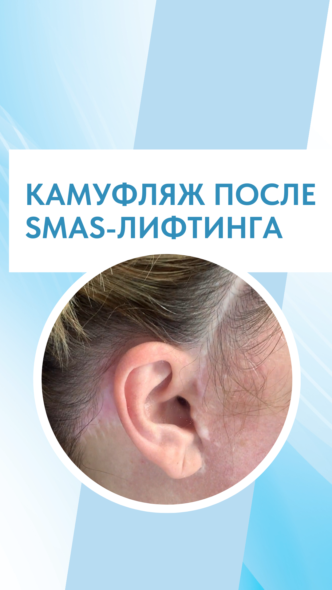 КАМУФЛЯЖ ПОСЛЕ SMAS-ЛИФТИНГА