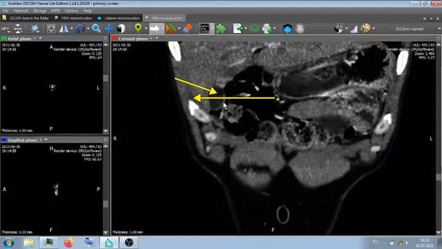 КТ АНГИОГРАФИЯ . ЗАВОРОТ . смотреть онлайн