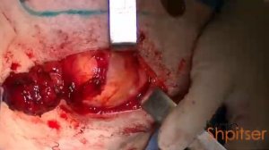 Большая эпидермоидная киста подчелюстной области