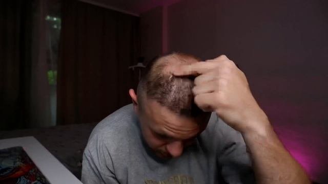 СБРИЛ ПЕРЕСАЖЕННЫЕ ВОЛОСЫ!!!!!ЗАЧЕМ???? 10 Месяцев после пересадки.
