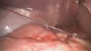 Лапароскопическое ушивание язвы 12 п.к. Оперативное лечение перфоративной язвы желудка и 12 п.к.