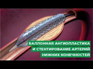 Баллонная ангиопластика и стентирование артерий нижних конечностей