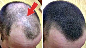 После втирания на месте лысин появляются здоровые волосы! Бальзам для роста волос сделать самому