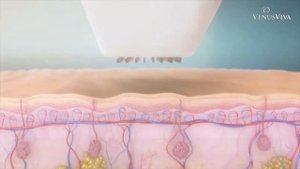 Микроигольчатый RF - лифтинг