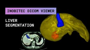 Сегментация печени в Inobitec DICOM Viewer Pro 2.3