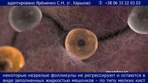 Синдром поликистозных яичников. СПКЯ