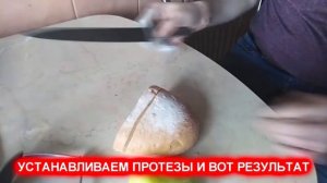 Протез пальца. Презентация.