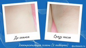 Электроэпиляция ног методом blend