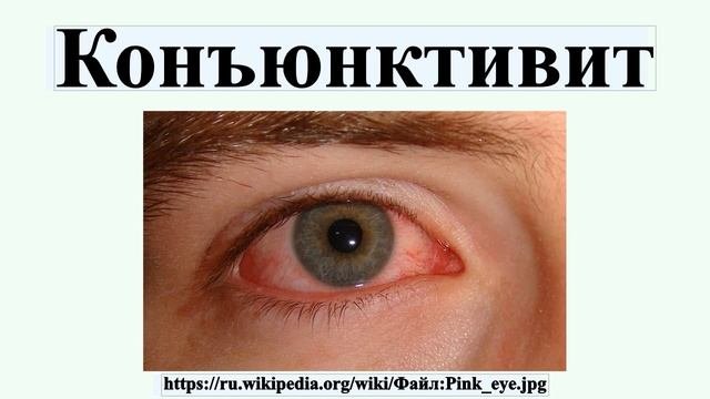 Конъюнктивит