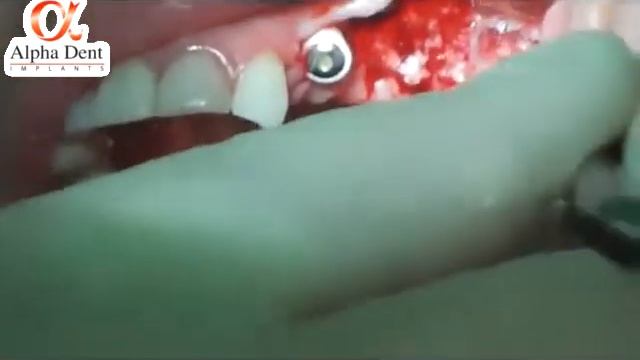 Video of an open sinus lift surgery , bone grafting , dental implantation смотреть онлайн