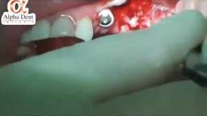 Video of an open sinus lift surgery , bone grafting , dental implantation