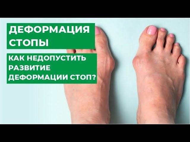Комбинированные деформации стопы. Вальгусная Hallux Valgus, ригидная Hallux Rigidus, молоткообразная