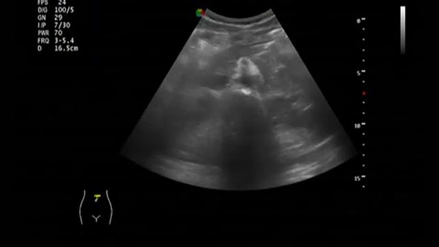 Ультразвуковая анатомия: Печень. Селезенка. Почки смотреть онлайн