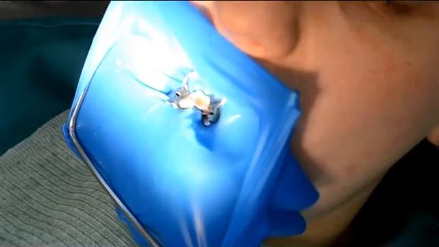 ДЕН-клиник Постановка пломбы смотреть онлайн