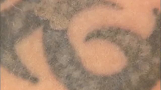 Удаление татуировки с помощью лазера смотреть онлайн